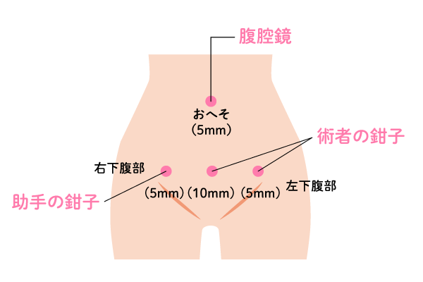 腹腔鏡下手術1