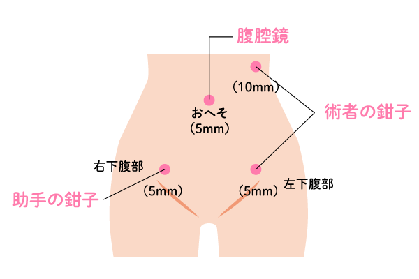 腹腔鏡下手術2