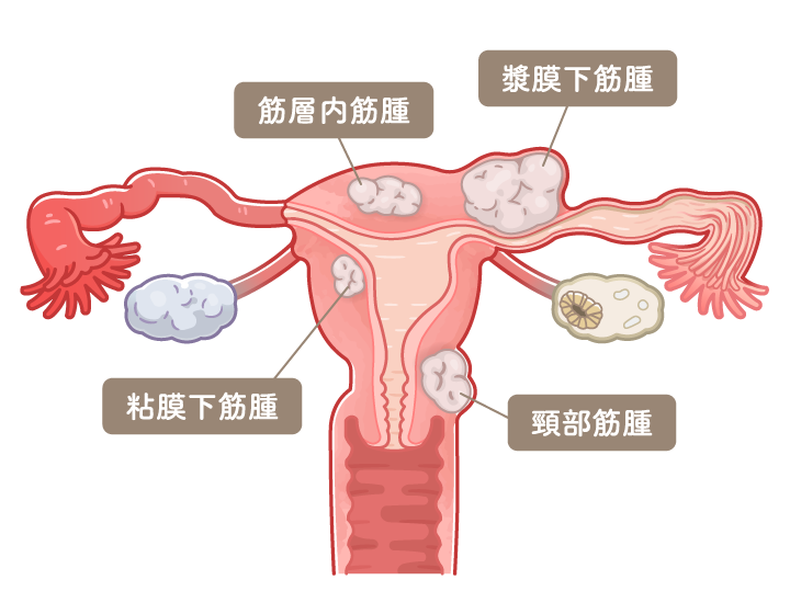 子宮筋腫