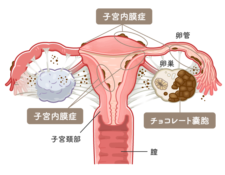 子宮内膜症