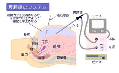 腹腔鏡下手術