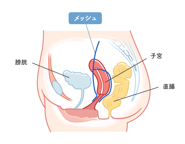 腹腔鏡下仙骨膣固定術