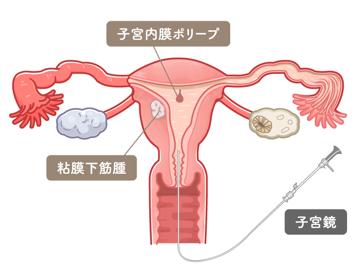 子宮鏡下手術